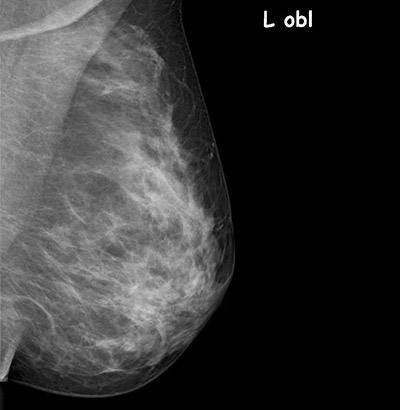 Aufnahme Brust nach Mammographie